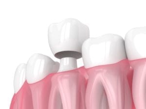 Dental Crown for Tooth Replacement in Dallas Texas
