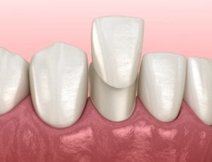 Porcelain Veneer to cover broken or discolored teeth
