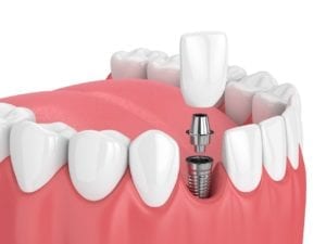 dallas, texas dental implants