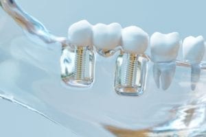affordable dental implants in dallas, texas