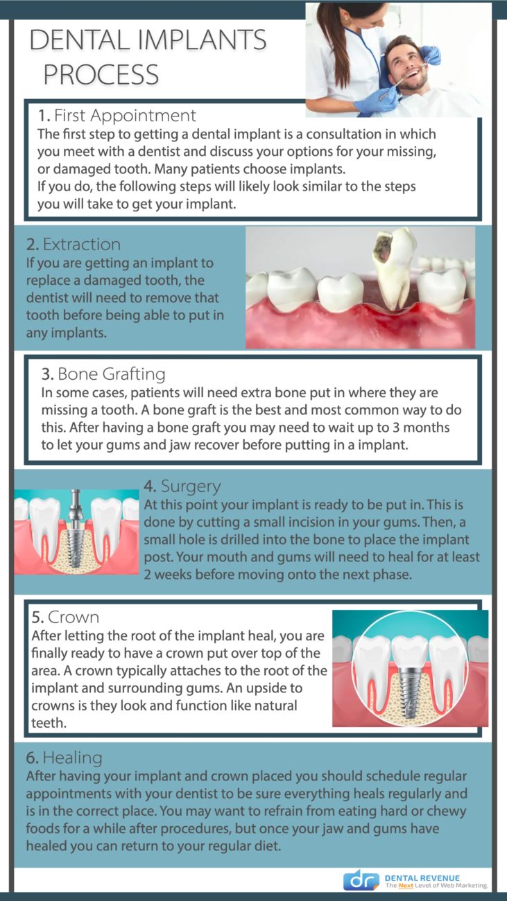 Dental implants process infographic