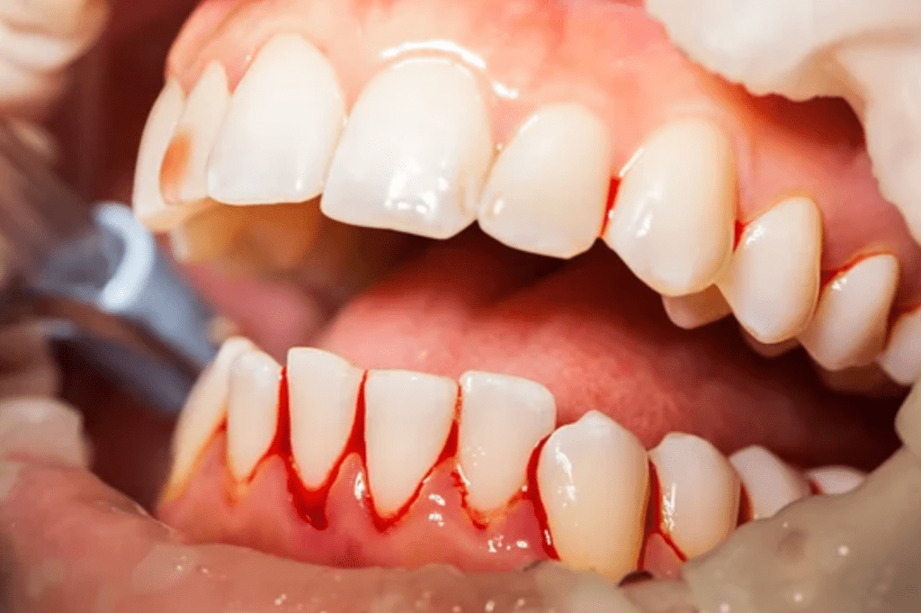 Close-up of bleeding gums receiving treatment gum disease dentist in Dallas Texas