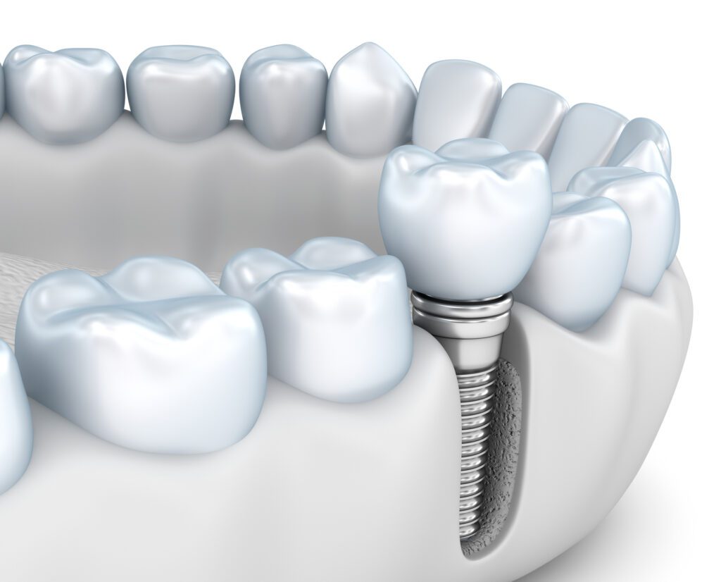 DENTAL IMPLANTS in DALLAS TX can help restore your bite after losing teeth