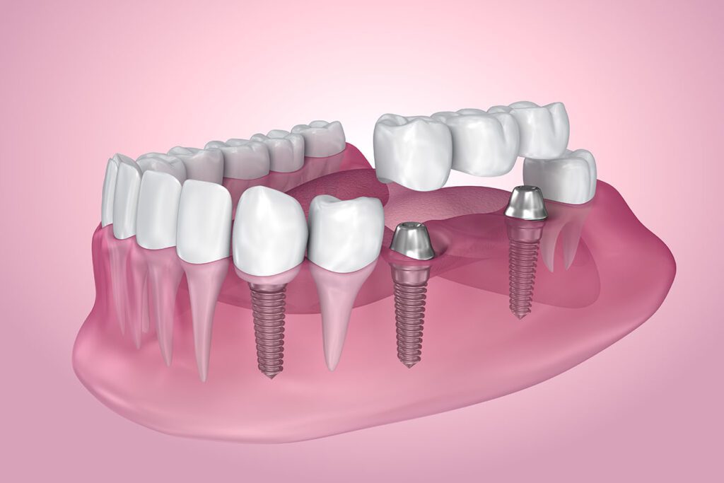 Choosing the right Dental Bridge in Dallas TX is crucial for proper restoration