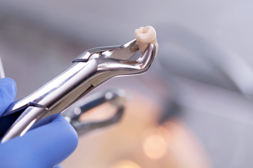 Understanding when you might need a tooth extraction can help you make informed decisions about your dental health.  