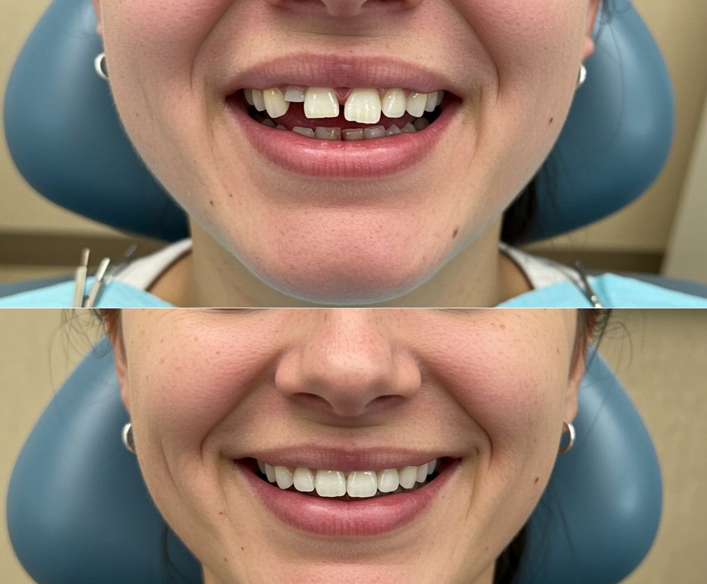 before and after cosmetic dentistry