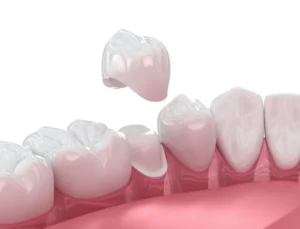 Dental Crowns 101: When a Filling Isn't Enough in Dallas, TX