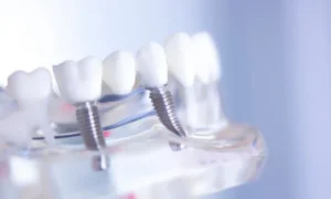Dental Implants vs. Bridges in Dallas, TX